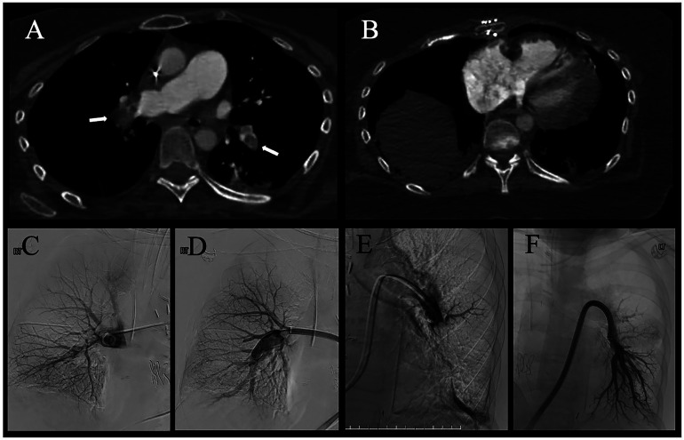 Large Bore Mechanical Thrombectomy for Right Atrial Thrombus and Pulmonary Embolism in the Early Post-Operative Period After Double Lung Transplantation.