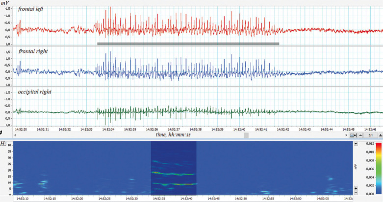 The neuronal density in the rostral pole of substantia nigra pars compacta in Wistar Albino rats from Rijswijk rats: A link to spike-wave seizures.