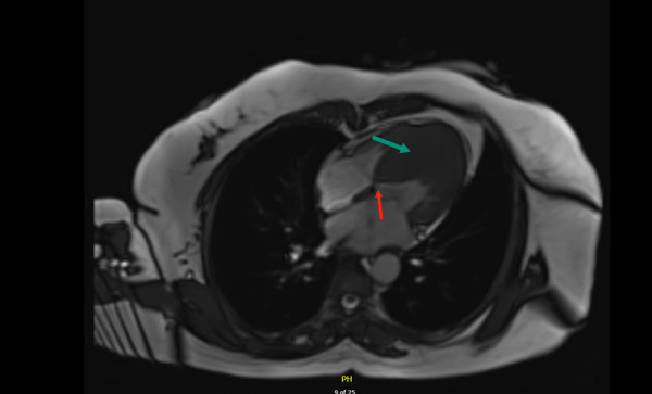Unrecognized Inter-Coronary Communication in a Case of Hypertrophic Cardiomyopathy.