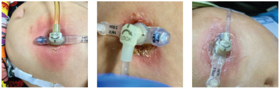 Is it Cellulitis Again? Erythema Concerning for Infection in Children With High-Risk Solid Tumors Who Have a Gastrostomy Tube.