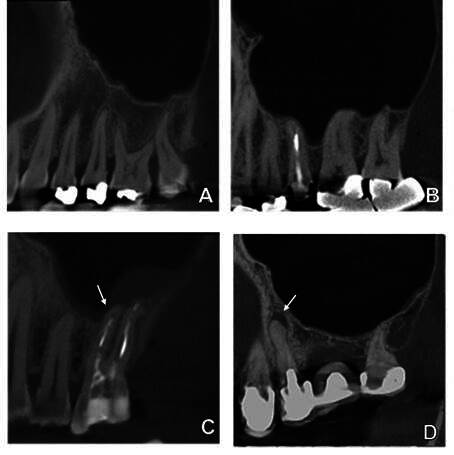 The relation between Schneiderian membrane thickening and radiodiagnostic features of periapical pathology.