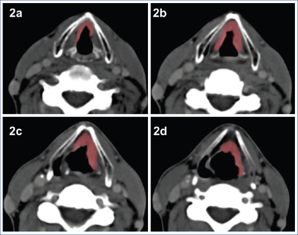 Predictors of Cervical Lymph Node Metastasis in Patients with Squamous Cell Carcinoma of the Larynx.