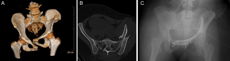 Review of the treatment options and results of earthquake-related pelvic injuries after the Türkiye earthquake on 6th February.