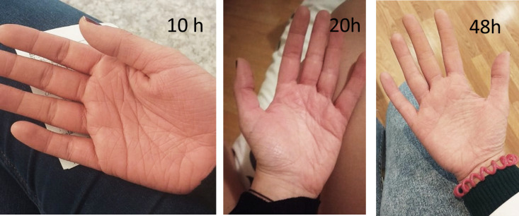 [Pharmaceutical Indication Service in a case of palmar-plantar erythema after amoxicillin and ibuprofen treatment].