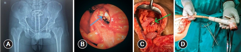 Minimally invasive techniques as adjuncts in low- versus high-lying retained rectal foreign bodies of autoerotic nature in young men: a tailored management algorithm with two contrasting case reports from India.