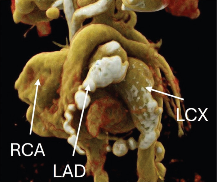 Systemic artery aneurysms - A marker of high-risk Kawasaki disease.