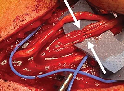 Hourglass Constrictive Neuropathy: A Likely Underdiagnosed Condition with Characteristic Imaging Features.