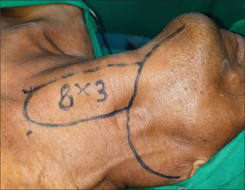 Infrahyoid myocutaneous flap for reconstruction in head and neck cancer patients.