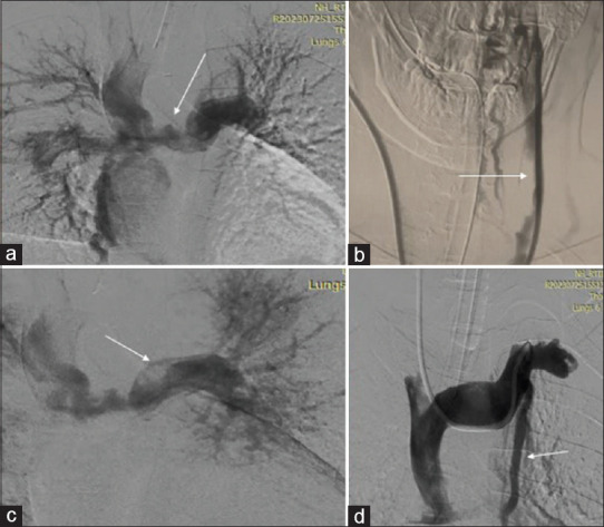 Transcatheter salvage of dying Glenn - An innovative strategy for postGlenn thrombosis.