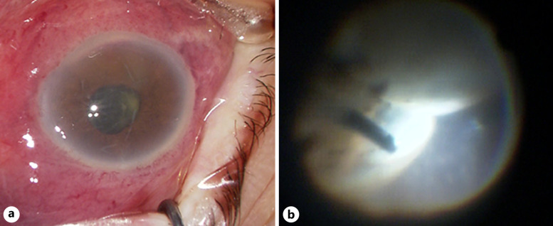 A Severe Case of Infectious Necrotizing Anterior Scleritis Caused by <i>Pseudomonas aeruginosa</i> after Vitreoretinal Surgery.