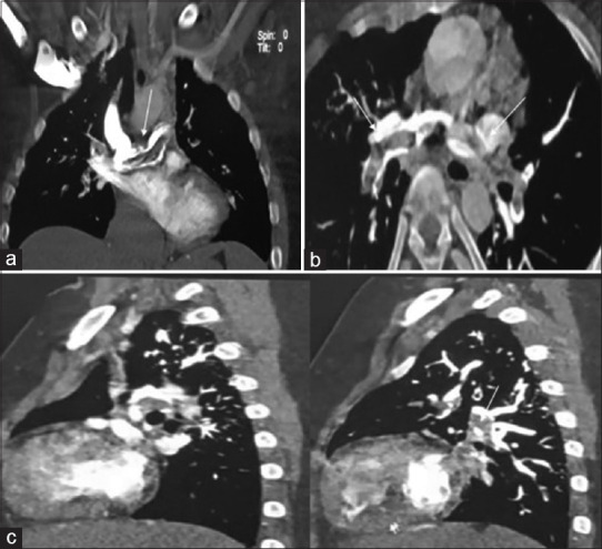 Transcatheter salvage of dying Glenn - An innovative strategy for postGlenn thrombosis.