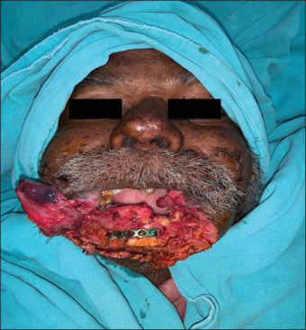 Hyena bite: A rare intriguing mode of maxillofacial injury, its management, risks involved, scenarios to avoid.
