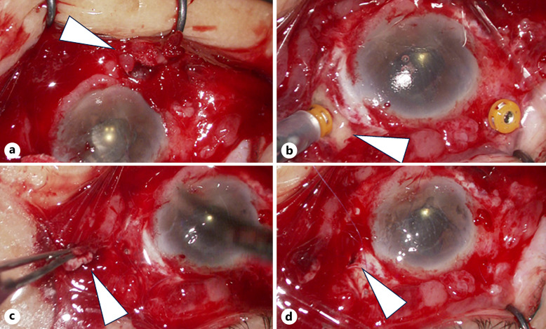 A Severe Case of Infectious Necrotizing Anterior Scleritis Caused by <i>Pseudomonas aeruginosa</i> after Vitreoretinal Surgery.