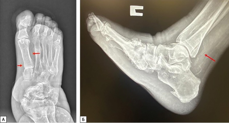 [Etiopathogenetic features of bone metabolism in patients with diabetes mellitus and Charcot foot].