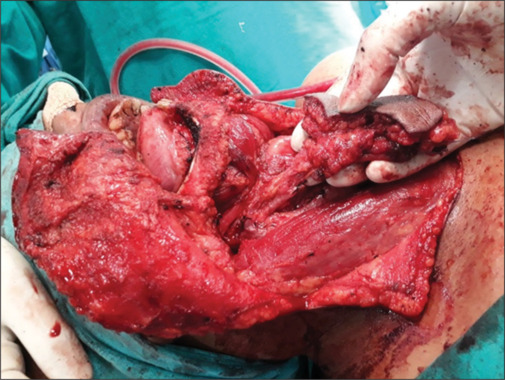 Infrahyoid myocutaneous flap for reconstruction in head and neck cancer patients.