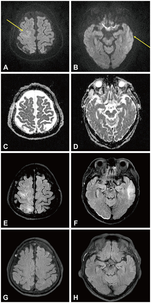 Refractory Status Epilepticus Associated With Dialysis Disequilibrium Syndrome.