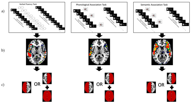 Assessing Language Lateralization through Gray Matter Volume: Implications for Preoperative Planning in Brain Tumor Surgery.