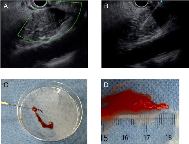 Multicenter, randomized controlled trial of EUS-guided fine-needle biopsy using a fork-tip needle with macroscopic or rapid on-site evaluation for pancreatic lesions (H<sub>2</sub>O trial).