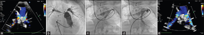 Early and midterm results of Cook Formula stent in children with right heart disease: A single-center experience.