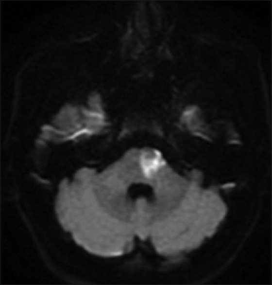 Intravenous thrombolysis plus tirofiban versus tirofiban alone in Caucasian patients with acute anterior choroidal or paramedian pontine infarction.