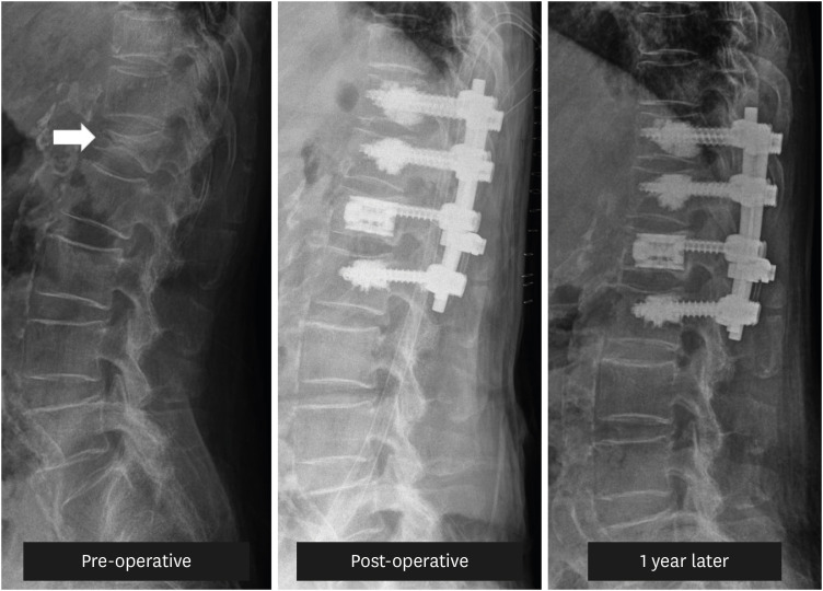 Pain Intervention for Osteoporotic Compression Fracture, From Physical Therapy to Surgery: A Literature Review.