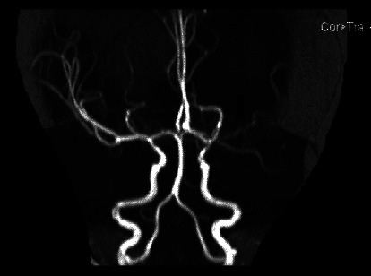 Tuberculosis Meningitis in a 9-Month-Old Girl during the COVID-19 Pandemic.