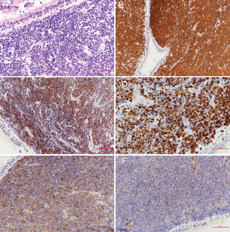 Immunoglobulin D-Lambda Multiple Myeloma Initially Presenting in the Sphenoid Sinus, Orbital Apex, and Skull Base: A Systematic Review with a Case Report.