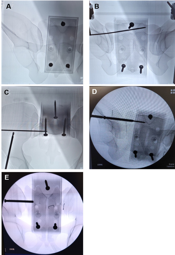 Improving surgical technical skills for emergency fixation of unstable pelvic ring fractures: an experimental study using a pelvic ring fracture simulator.