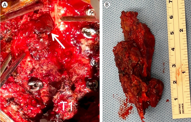Preoperative embolization and en bloc resection of a metastatic pheochromocytoma of the cervical spine.