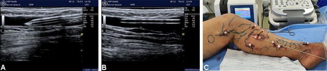 Endovenous laser ablation for saphenous veins and tributaries - the LEST technique.
