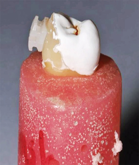 Effect of Different Liquids and Thermal Aging Procedures on the Shear Bond Strength of APC II, APC Flash-Free, and Conventional Ceramic Brackets: An <i>In Vitro</i> Study.
