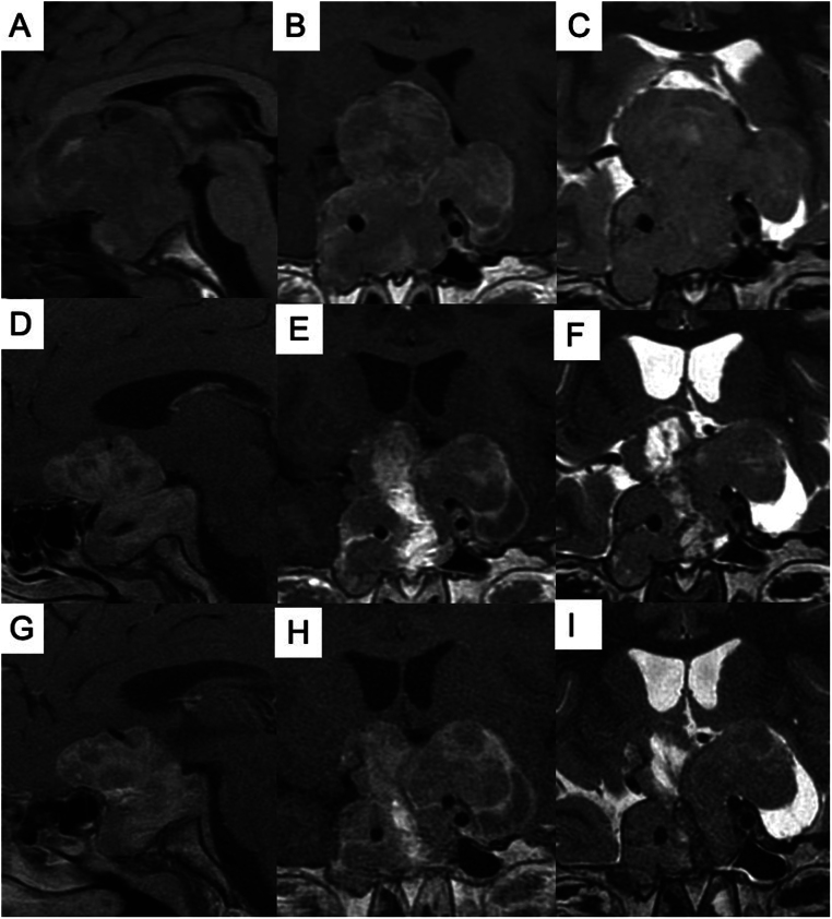 Pituitary gigantism due to a novel <i>AIP</i> germline splice-site variant.