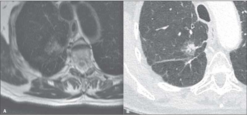 Look-Locker T1 relaxometry and high-resolution T2 in the evaluation of lung lesions: a single-center prospective study.