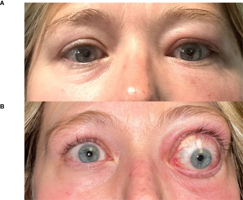 Iodine contrast should be avoided in patients with thyroid eye disease.