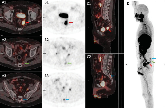 Sacral Radiculoplexopathy Caused by Direct Perineural Spread of Carcinoma Prostate Diagnosed in Ga-68 PSMA PET/CT.