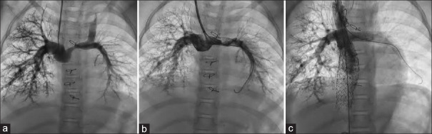 Early and midterm results of Cook Formula stent in children with right heart disease: A single-center experience.