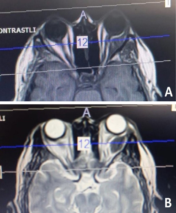 Orbital Metastasis from Breast Cancer: Three Cases and Brief Review of the Literature.
