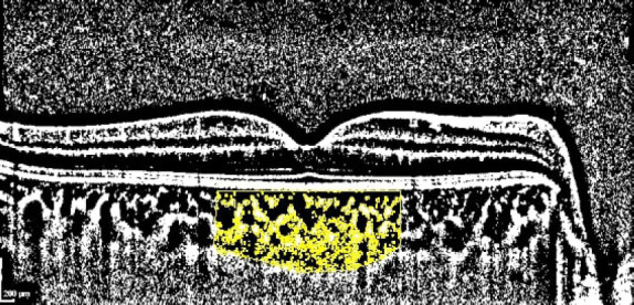 Evaluation of Choroidal Structures in Children with Newly Diagnosed Type-1 Diabetes Mellitus.