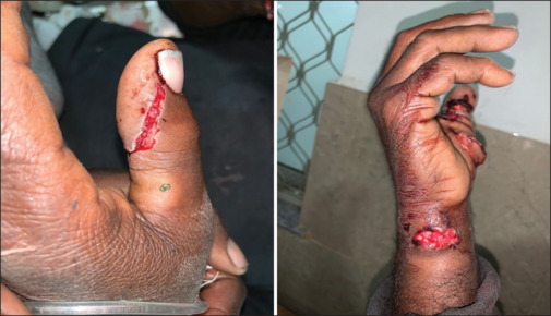 Hyena bite: A rare intriguing mode of maxillofacial injury, its management, risks involved, scenarios to avoid.