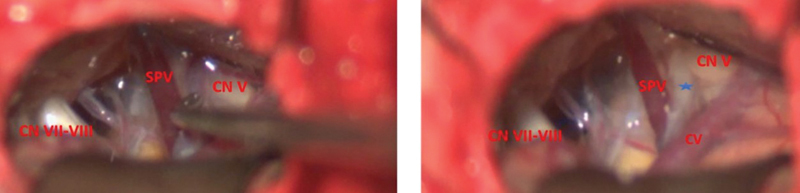 Microvascular Decompression: An Effective Approach for Trigeminal Neuralgia Caused by a Dolichoectatic Basilar Artery after Multiple Treatment Failures.
