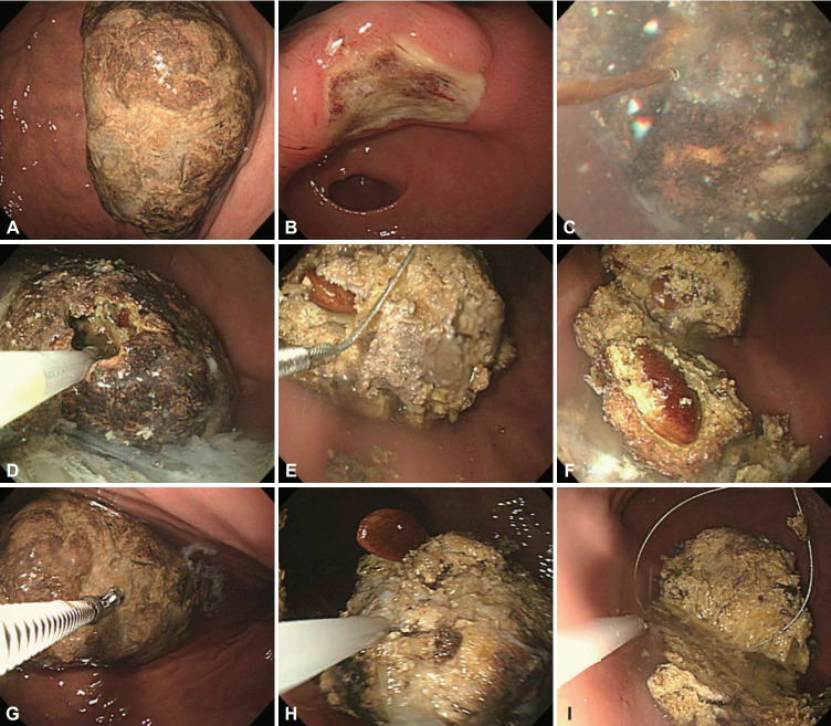 Clinical Outcomes of Patients With Gastric Phytobezoars: Implication of Drinking Carbonated Beverages as a Treatment.