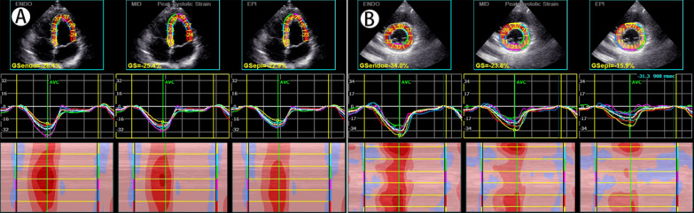 Assessment of left ventricular myocardial systolic dysfunction in premature ovarian insufficiency patients using echocardiographic layer-specific myocardial strain imaging.
