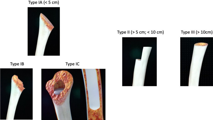 Revision shoulder arthroplasty and proximal humeral bone loss: a comprehensive review and proposal of a new algorithm of management.
