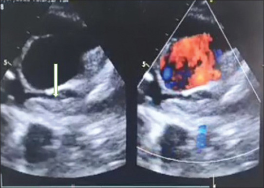 Transcatheter salvage of dying Glenn - An innovative strategy for postGlenn thrombosis.