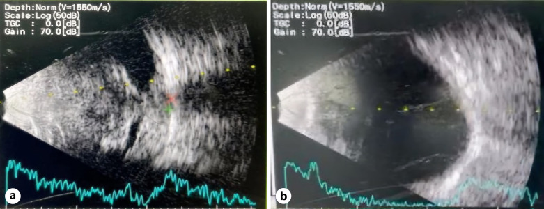 Management of Painful Blind Eye with Bilateral Symblepharon: A Case Report.
