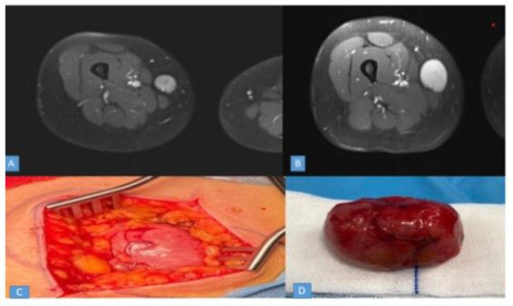 Rapidly Growing Leiomyoma Mimicking Schwannoma of the Saphenous Nerve in the Lower Extremity: An Unusual Case Report.