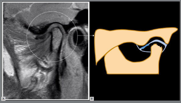 Unveiling MRI-based structural phenotypes in temporomandibular joint osteoarthritis: implications for clinical practice and research.