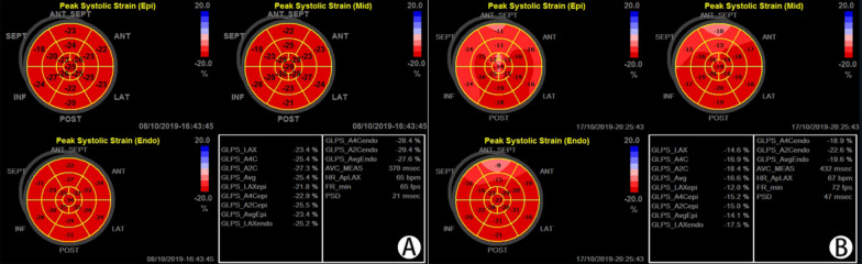 Assessment of left ventricular myocardial systolic dysfunction in premature ovarian insufficiency patients using echocardiographic layer-specific myocardial strain imaging.
