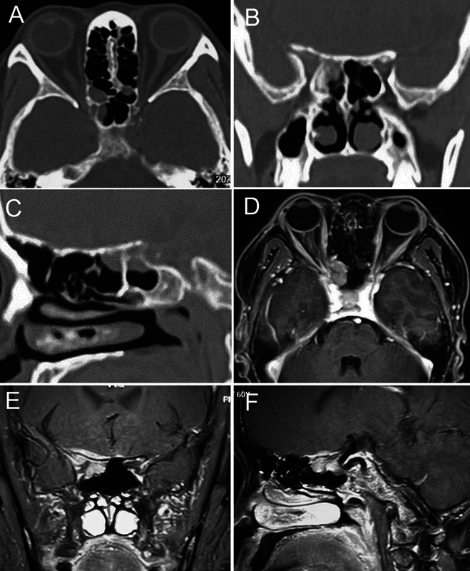 Immunoglobulin D-Lambda Multiple Myeloma Initially Presenting in the Sphenoid Sinus, Orbital Apex, and Skull Base: A Systematic Review with a Case Report.