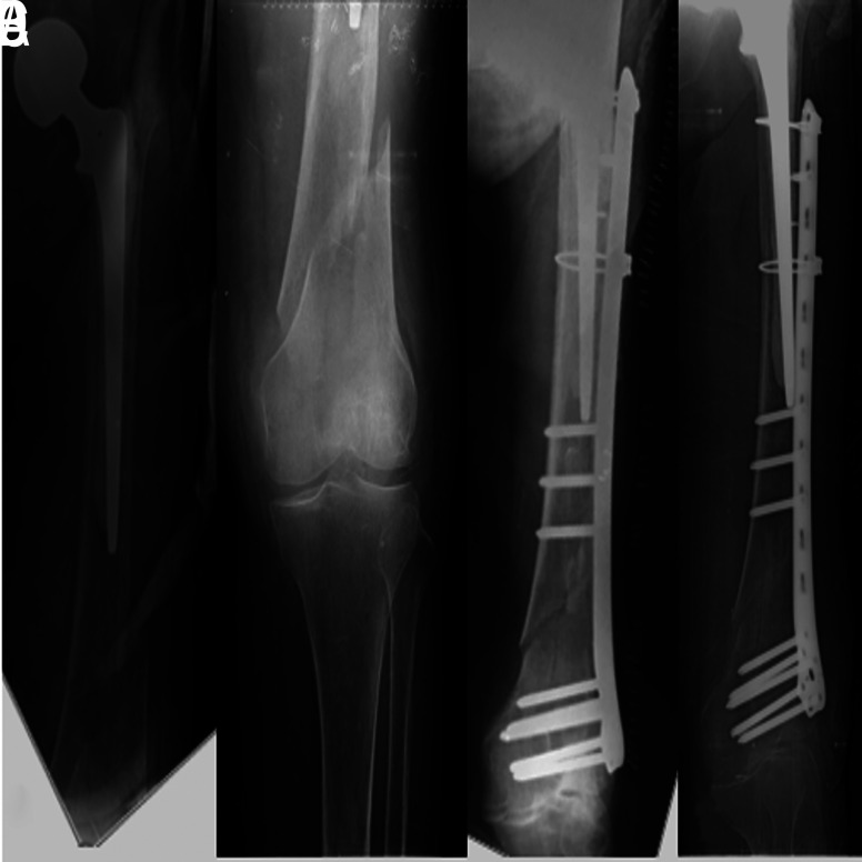 Surgical outcomes of cable plate fixation in treatment of Vancouver type B1 and type C periprosthetic femoral fractures: a retrospective case series.